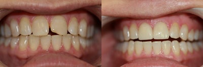 Invisalign before and after photo