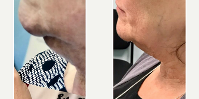 Kybella before and after photo