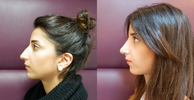 Rhinoplasty before and after photo