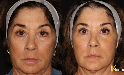 Sculptra before and after photo