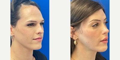 Facial Feminization Surgery before and after photo