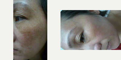 Fractional Laser before and after photo