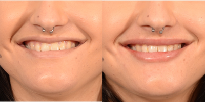 Lip Fillers before and after photo