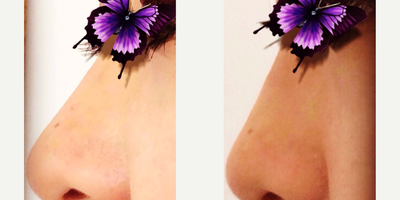 Nonsurgical Nose Job before and after photo