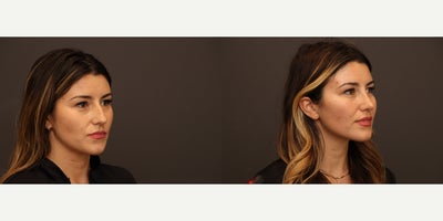 Rhinoplasty before and after photo