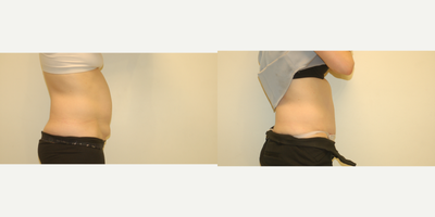 Tummy Tuck before and after photo