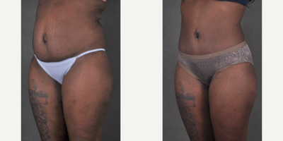 Tummy Tuck before and after photo
