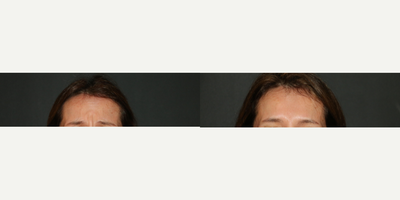 Botox before and after photo