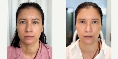 Brow Lift before and after photo