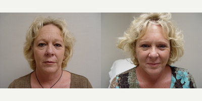 Eyelid Surgery before and after photo