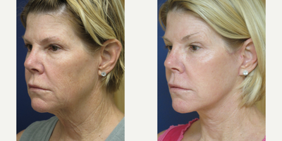 Facelift before and after photo
