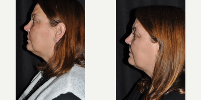 Kybella before and after photo