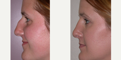Rhinoplasty before and after photo