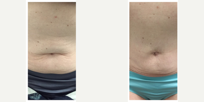 Skin Tightening before and after photo