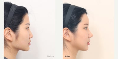 Chin Implant before and after photo