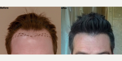 FUE Hair Transplant before and after photo