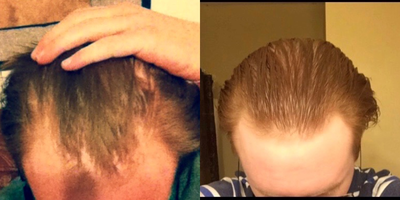 Hair Loss Treatment before and after photo