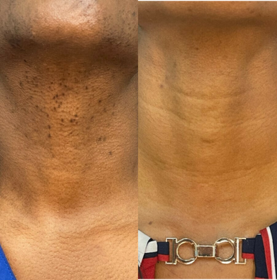 Laser Hair Removal before and after photo