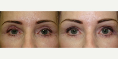 Restylane before and after photo