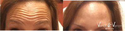Botox before and after photo