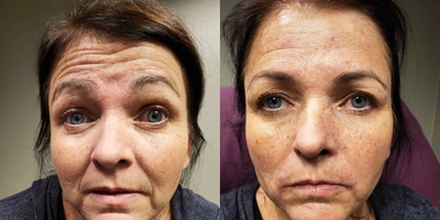 Botox before and after photo