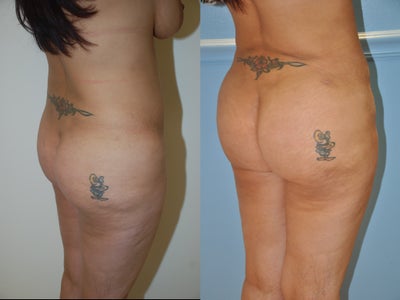Brazilian Butt Lift before and after photo