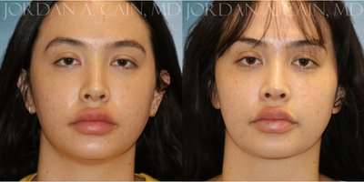Chin Liposuction before and after photo