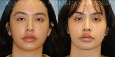 Chin Liposuction before and after photo