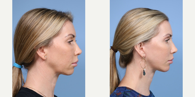 Deep Plane Facelift before and after photo