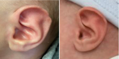 Ear Surgery before and after photo