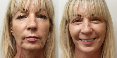 Facelift before and after photo