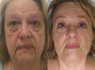 Facelift before and after photo