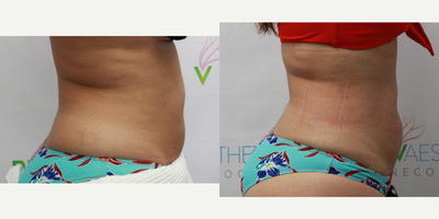 Smart Lipo before and after photo
