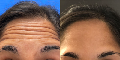 Botox before and after photo