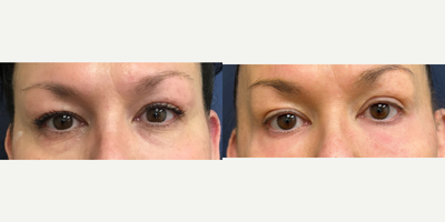 Chemical Peel before and after photo