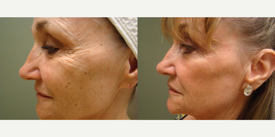 CO2 Laser before and after photo
