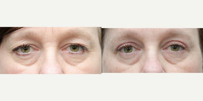 Eyelid Surgery before and after photo