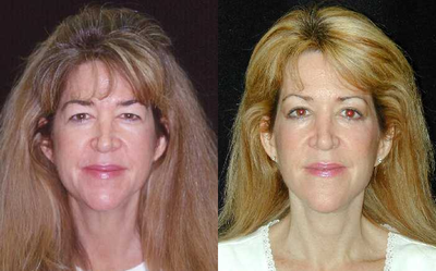 Facelift before and after photo