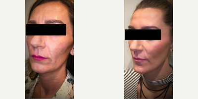 Juvederm before and after photo