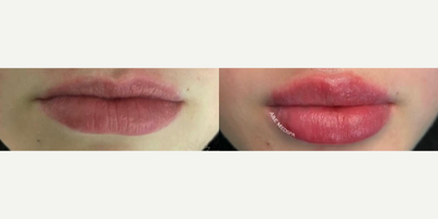 Lip Fillers before and after photo