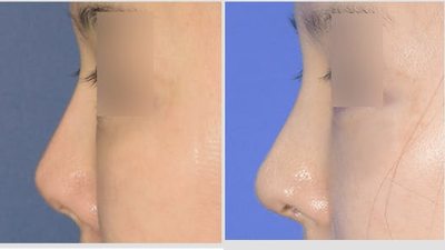 Rhinoplasty before and after photo