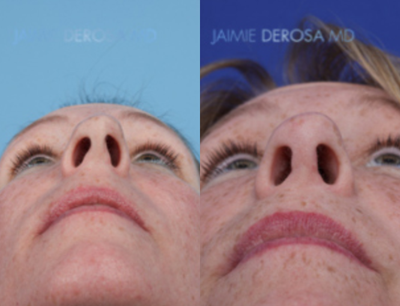 Rhinoplasty before and after photo