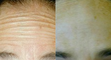 Botox before and after photo