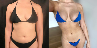 Breast Implants before and after photo