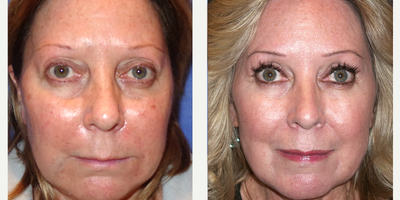 CO2 Laser before and after photo