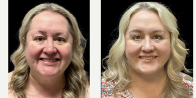 Facelift before and after photo