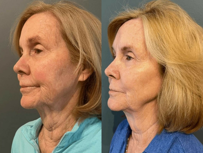 Sofwave before and after photo
