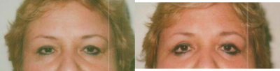 Eyelid Surgery before and after photo