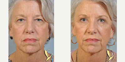 Eyelid Surgery before and after photo