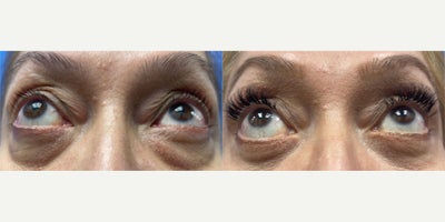 Eyelid Surgery before and after photo